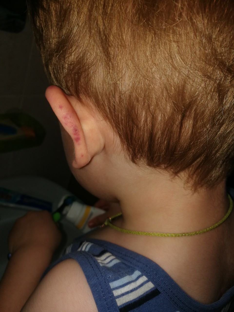 Ребенку год ударился затылком. Красное пятно на ухе у ребенка.