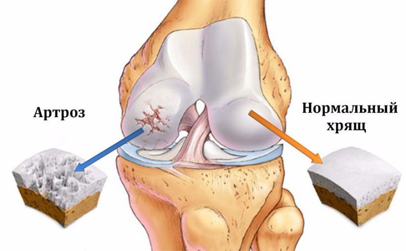 гонартроз 2 степени