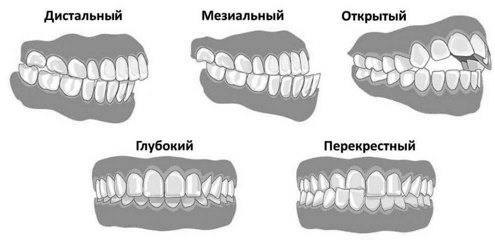 Из за неправильного прикуса болит ухо